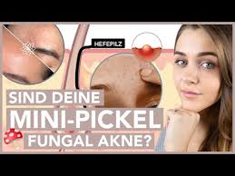 Fungal Akne So Wirst Du Sie Garantiert Los In 5 Tagen