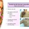 Bagi wanita, kanker payudara menjadi momok tersendiri. Https Encrypted Tbn0 Gstatic Com Images Q Tbn And9gcsgpkfxo8ebuv3oqbnsbnlcuzh7id4budslmzc04h8x4zsjswbv Usqp Cau