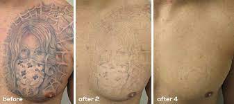 The Best Tattoo Removal Options And Alternatives Laser Tattoo Removal Laser Tattoo Tattoo Removal Cost