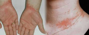 Image result for dermatitis contacta allergica
