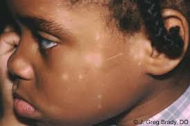 Pityriasis alba is a skin disorder that mostly affects children and young adults. Derm Photos Flashcards Chegg Com