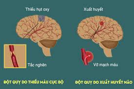 Nguyên nhân qua đời của nghệ sĩ chí tài là đột quỵ. 7 Thoi Quen Xáº¥u Dá»… Gay Ä'á»™t Quá»µ Cáº§n Ä'Æ°á»£c Loáº¡i Bá» An Nao