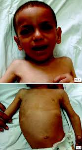 A Child with Hoarse Cry, Subcutaneous Nodules and Joint Contracture