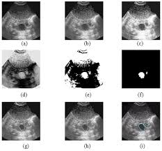 The uterus may be oblique and squash the ovary giving it a flattened ovoid shape. Follicle Detection And Ovarian Classification In Digital Ultrasound Images Of Ovaries Intechopen