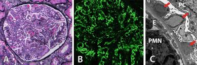As the wiki is getting an extensive overhaul, any content added to this page may get deleted in the near future! Poststreptococcal Glomerulonephritis A Light Microscopy Global Download Scientific Diagram