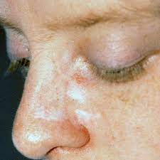 If you have skin cancer, it is important to know which type you have because it affects your treatment options and your outlook (prognosis). Focus On Eyelid Skin Cancers Early Detection And Treatment The Skin Cancer Foundation