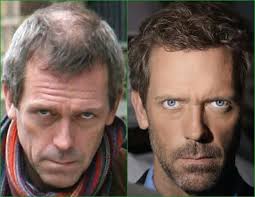 Grazie al fatto che la chirurgia estetica dei . Trapianto Capelli Personaggi Famosi