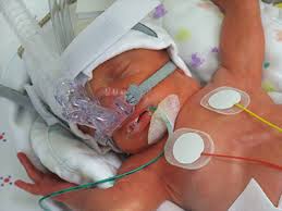 Image result for Preterm Infant