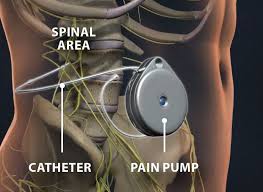 Image result for Intrathecal Pump