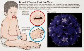Coxsackie virus is caused by several different viruses, the most common of which is coxsackievirus a16. Hannahrayyan Shoppe Alternatif Rawatan Hand Foot Mouth Disease Hfmd