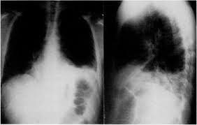 Untreated esophagitis may progress to metaplastic columnar epithelium similar to barrett's esophagus in humans.26 the most. Atypical Pulmonary Diseases Associated With Aids Chest