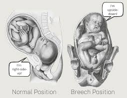 Image result for Breech Delivery