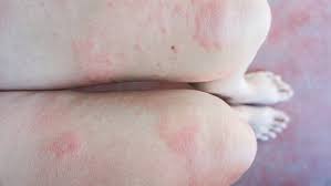 Check spelling or type a new query. Makrophagenaktivierungssyndrom Symptome Und Behandlung Ndr De Ratgeber Gesundheit