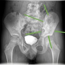 Bone pain, tenderness (especially back, ribs; Ewing Sarcoma In Children And Teens Together