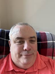 One week after brain surgery #4!