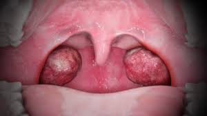 Image result for Tonsillitis