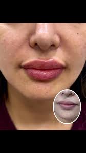 Fresh lip plump👄because details matter✨🤍, 📌عناوين العيادات :,