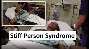 Symptoms may occur gradually, spreading from the back and legs to involve the arms and neck. Stiff Person Syndrome Youtube
