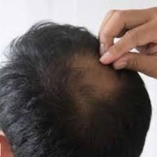 Orang lelaki, sebelum kepala hampir botak, buat & elak 10 benda ini dulu! Lelaki Umur Belum 30 Tahun Tapi Rambut Dah Nipis Ambil Tahu 10 Perkara Ini Untuk Elak Rambut Gugur