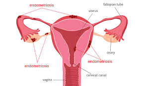 Endometriosis affects an estimated 176 million women worldwide regardless of their ethnic and social endometriosis is a condition where tissue similar to the lining of the uterus (the endometrial. Understanding Endometriosis Health Plus
