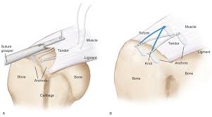 Image result for Rotator Cuff Triad Test