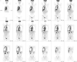 We did not find results for: Early Prediction Of Response To Chemotherapy And Survival In Malignant Pleural Mesothelioma Using A Novel Semiautomated 3 Dimensional Volume Based Analysis Of Serial 18f Fdg Pet Scans Journal Of Nuclear Medicine