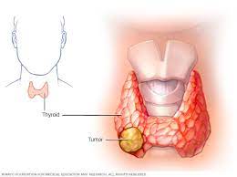 Unexplained hoarseness that lasts for more than a few weeks a sore throat or difficulty swallowing that doesn't get better Thyroid Cancer Symptoms And Causes Mayo Clinic