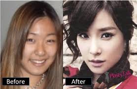 Korean Celebrity Plastic Surgery Photo 1 See How To Become An Instagram Model Here Celebrity Plastic Surgery Plastic Surgery Photos Plastic Surgery Pictures
