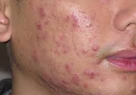 Jerawat dah hilang tak semestinya melegakan hati. Petua Hilangkan Bekas Jerawat Di Muka Dengan Bahan Semulajadi