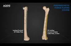 Aosys Femur GT Cable Plate System and VA Locking Curved Condylar cable plate