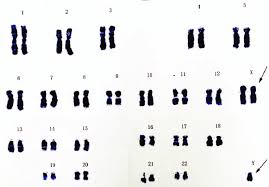 Chromosome Karyotype Examination Showing 47 Xxy Chromosome