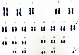 chromosome karyotype examination showing 47 xxy chromosome