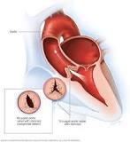 Image result for icd 9 code for aortic valve disorder