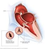 Image result for icd 10 code for av stenosis