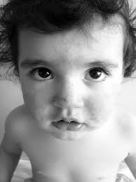 Gianotti-crosti sendromu