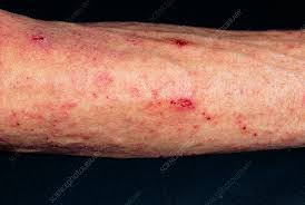 Image result for what does scabie look like