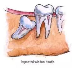 The crowns of wisdom teeth are usually completed between ages 12 to 16 years. How Long Do Wisdom Teeth Take To Grow Quora