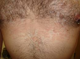 Check spelling or type a new query. Young Man With A Rash On His Chest