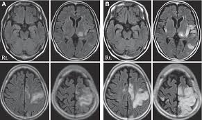 There is no particular age, sex, or seasonal predilection. Herpes Simplex Encephalitis Presenting As Stroke Like Symptoms With Atypical Mri Findings And Lacking Cerebrospinal Fluid Pleocytosis Semantic Scholar
