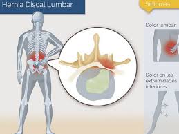Maybe you would like to learn more about one of these? La Mejor Postura Para Dormir Con Una Hernia Neurocirugia De La Torre