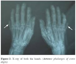 Image result for Supernumerary Digit