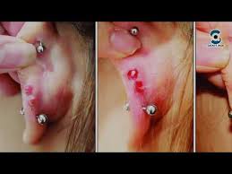 Mega preiswert bei crazy factory! How To Treat An Infected Ear Piercing Simple Home Remedy To Get Rid Of Piercing Infection Quickly Youtube