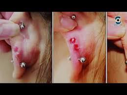 The lumps, called granulomas, are trapped fluid. How To Treat An Infected Ear Piercing Simple Home Remedy To Get Rid Of Piercing Infection Quickly Youtube