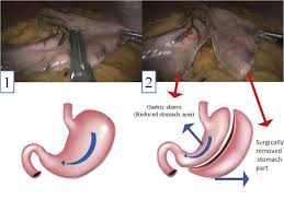 This article compares everything from weight loss to operating times, to complications. The Advantages And Disadvantages Of Sleeve Gastrectomy Clinical Laboratory To Bedside Review Sciencedirect