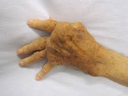 Rheumatoid Arthritis Wikipedia