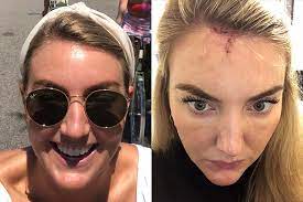 Cancer is a scary word coming from your doctor. Skin Cancer At 30 Mohs Surgery Experience