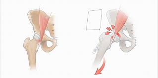 Image result for Snapping Hip