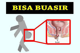 Buasir (hemoroid/hemorrhoid) adalah salah satu penyakit yang amat bahaya sekiranya tidak mencegah dan dirawat dengan cepat. Auc Fakiah Bisa Buasir Penyebab Berak Berdarah Facebook