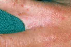 Image result for scabies human bites