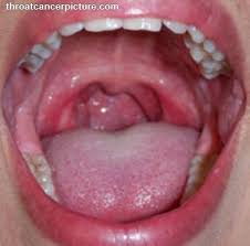 Squamous cell carcinomas of the mouth often look like open sores (ulcers) and tend to grow into the underlying tissues. Throat Cancer Pictures Early Celine Dion Songs Age